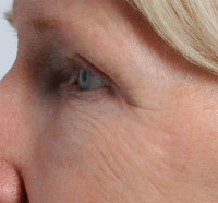 A close up, side profile of a woman's face showing crows feet before using non-fractional laser technology