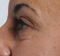 A close up, side profile of a woman's eye before using non-fractional laser technology