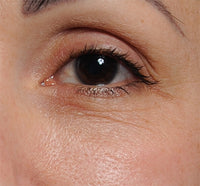 Close up of a woman's eye before using NIRA