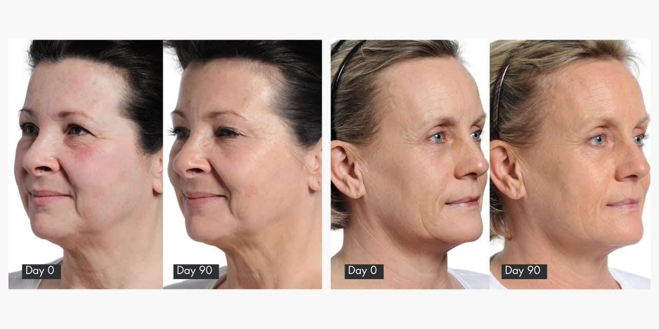 90 day results of treating dry skin with a NIRA laser