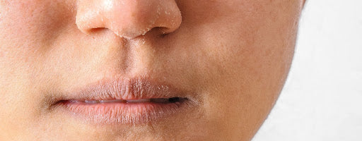 dry flaky skin around lips and nose