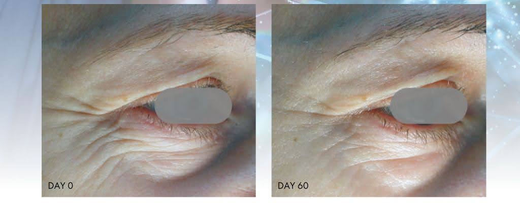 60 day results of using Matrixyl 3000 for eye wrinkles