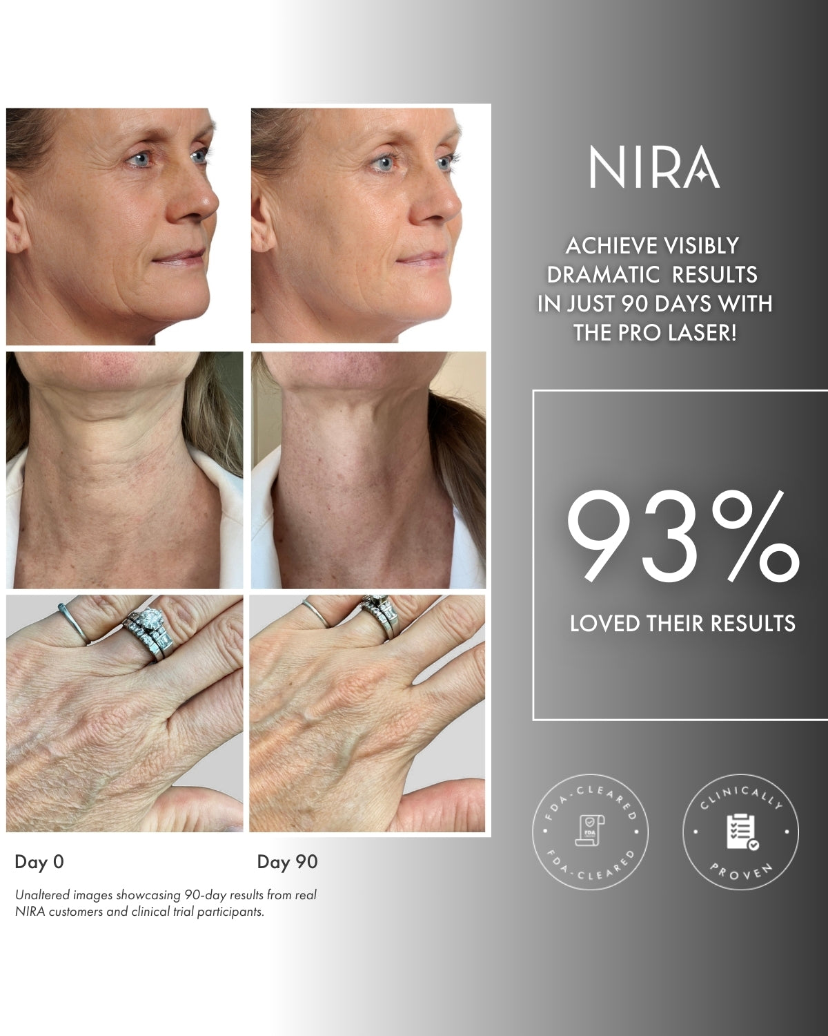 NIRA Pro Laser | Wrinkle Reducing & Skin Tightening Laser Device