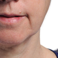 Close up of a woman's mouth before using NIRA's at-home laser